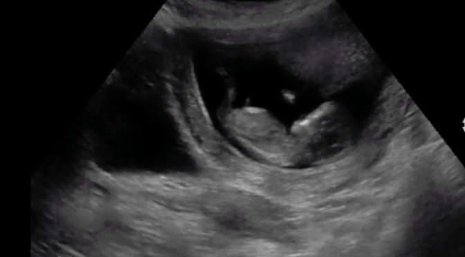 In 2009 two midwives urged their pregnant patients to leave town before a 1080 drop – hear the late Dr Scanlon speak on the lack of research on the potential risks to the unborn