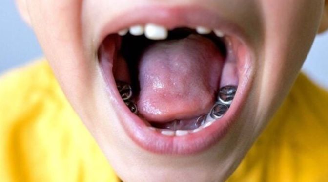 silver fillings - mercola